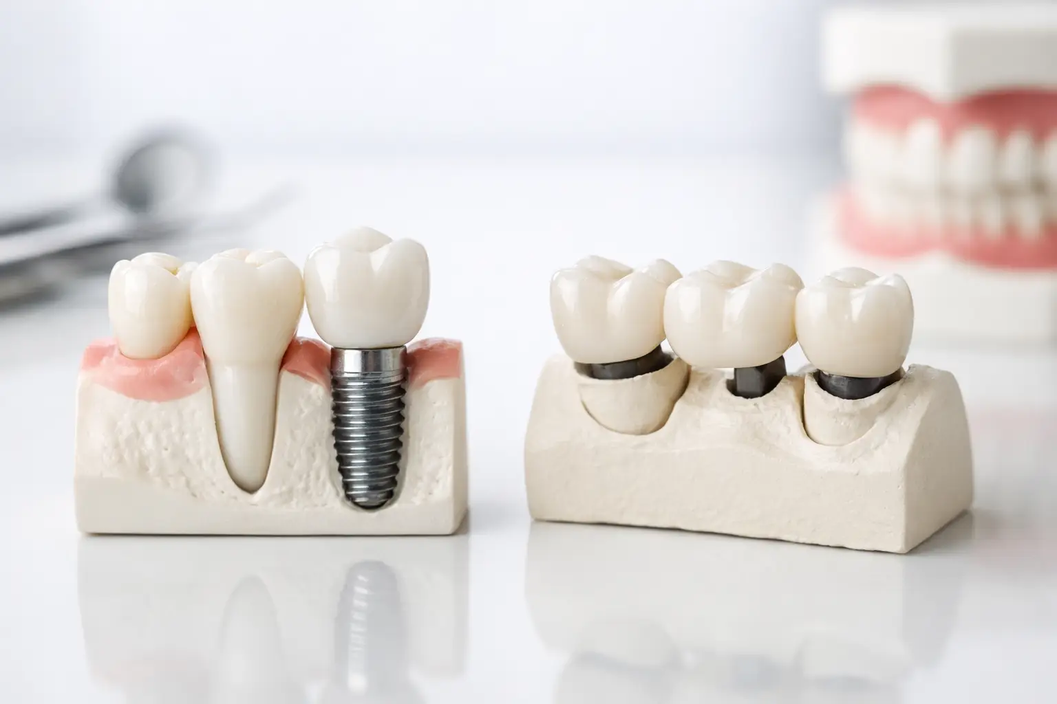Impianto dentale o ponte fisso: quale scegliere?